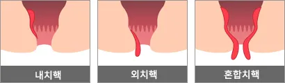 치핵