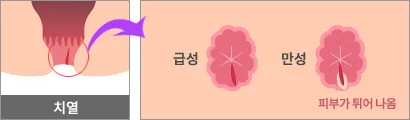 치열