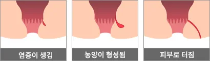 치루