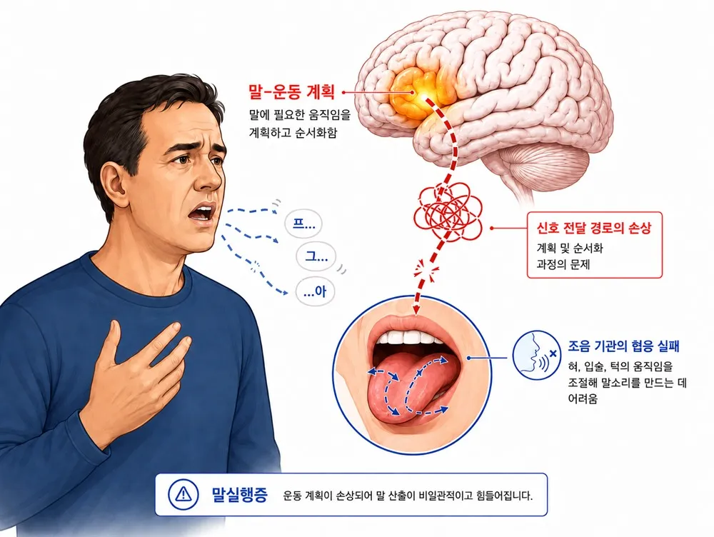 말실행증 - 말·운동 계획
